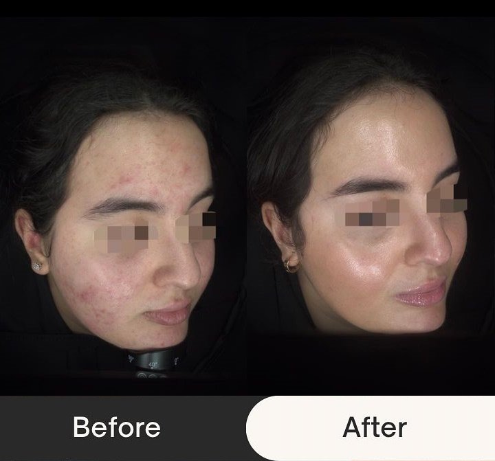 acne_before_and_after_1